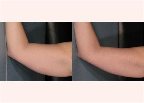 velashape folsom|Patient .